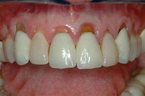 gum graft henderson nevada